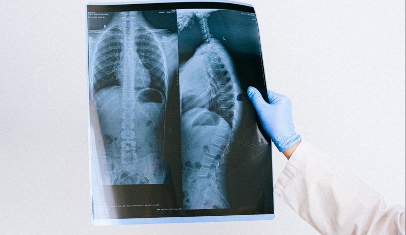 Spinal X-Ray